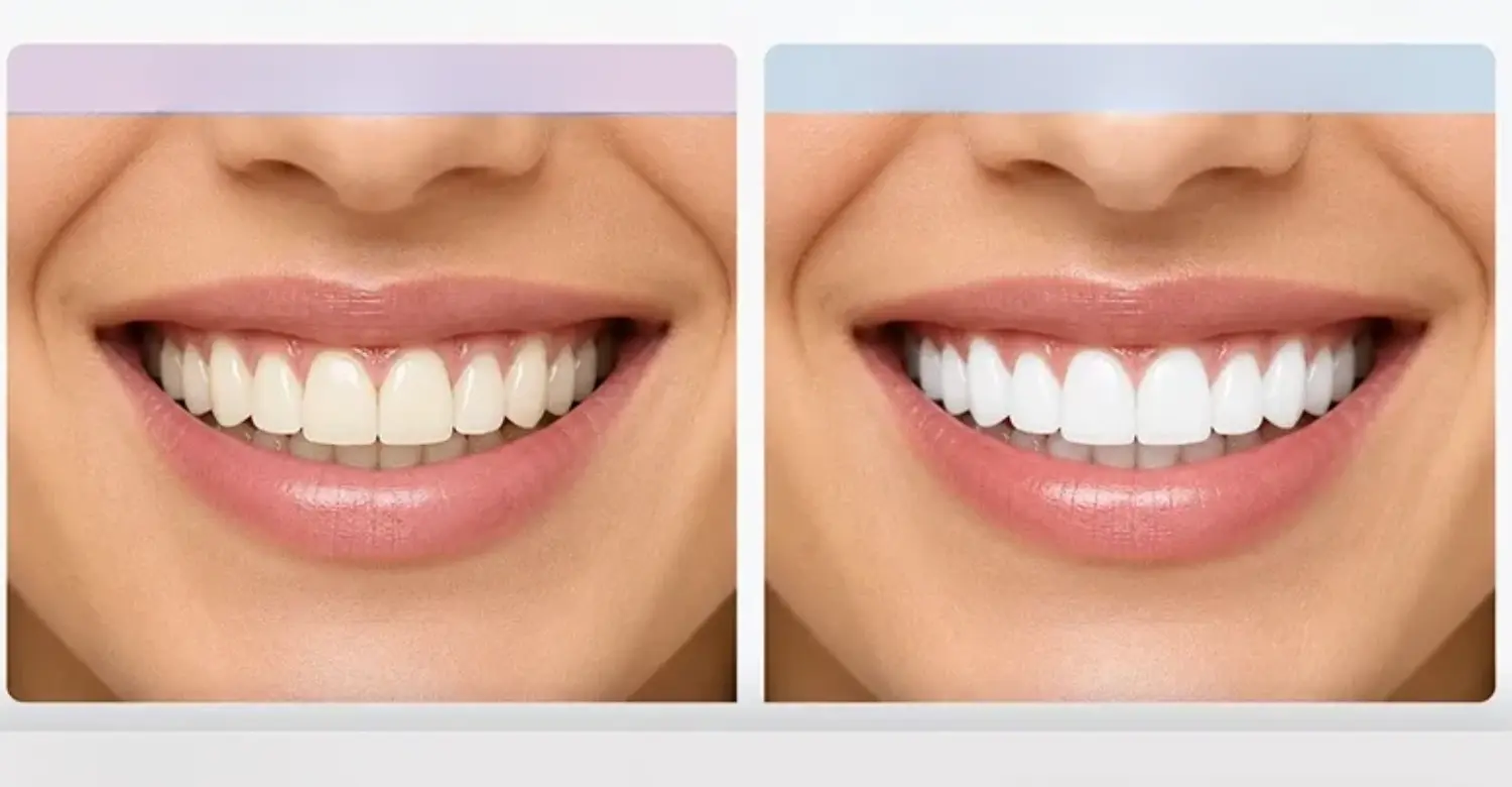 Hollywood smile 2